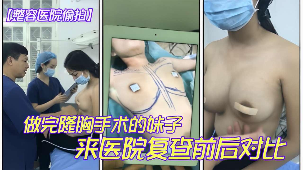 整容医院偷拍做完隆胸手术的咪子来医院复查前后对比-极品